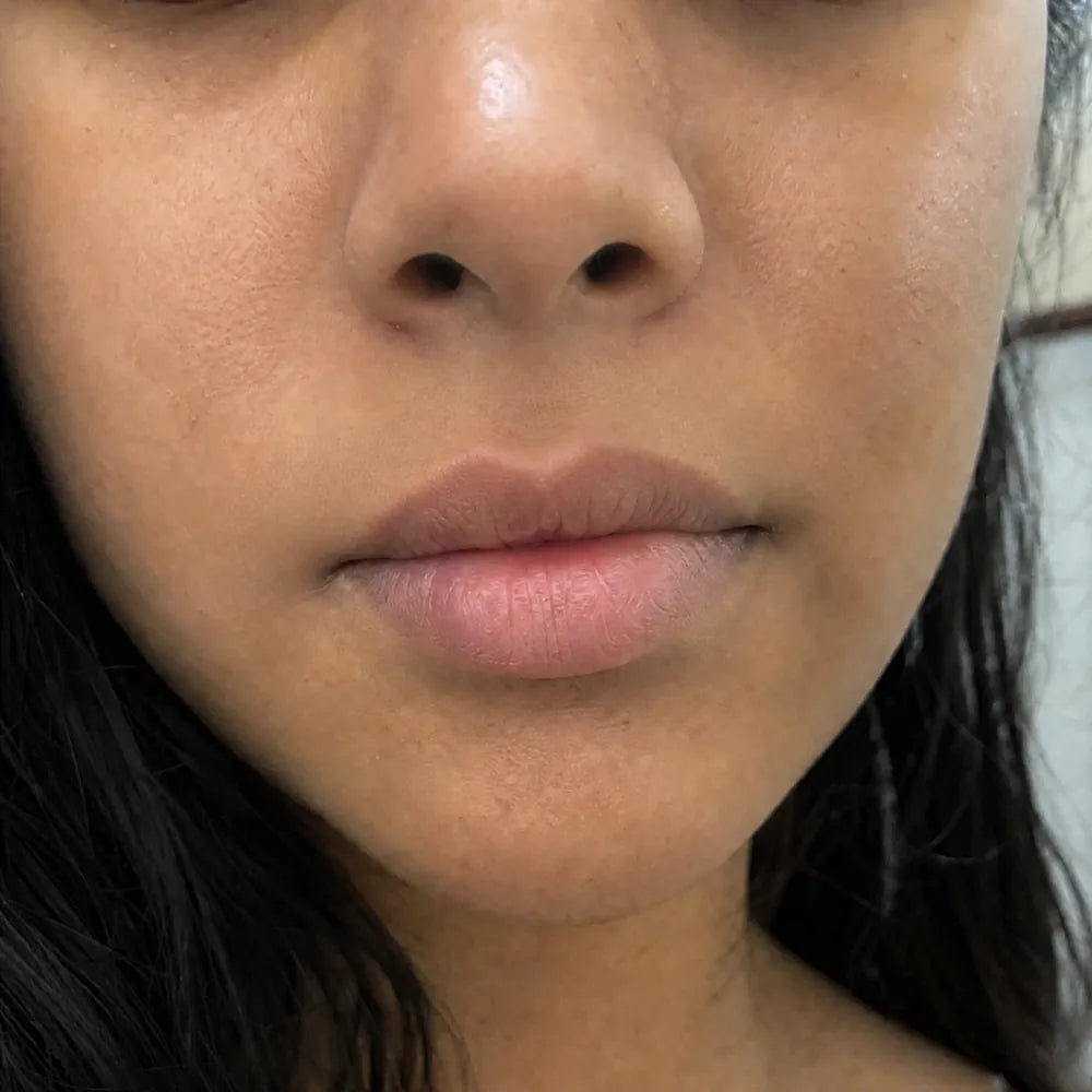 Upper lip after Peach Sands
