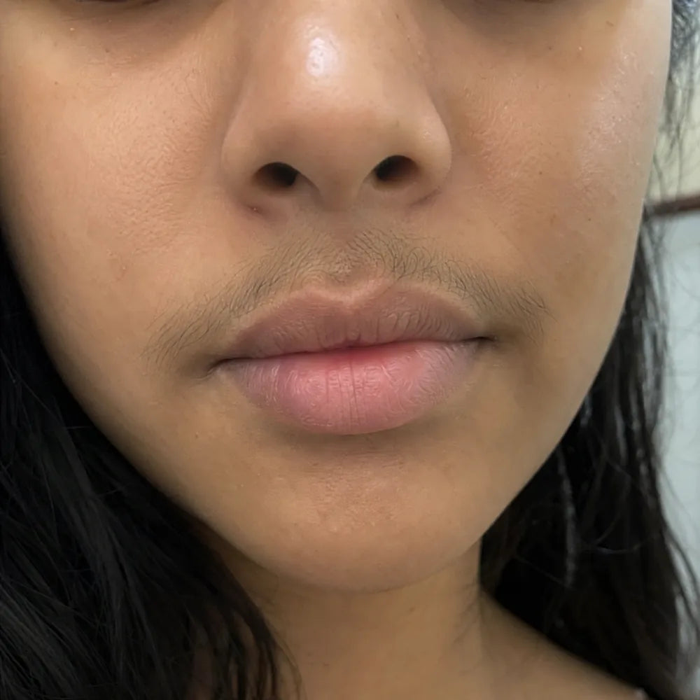 Upper lip before Peach Sands